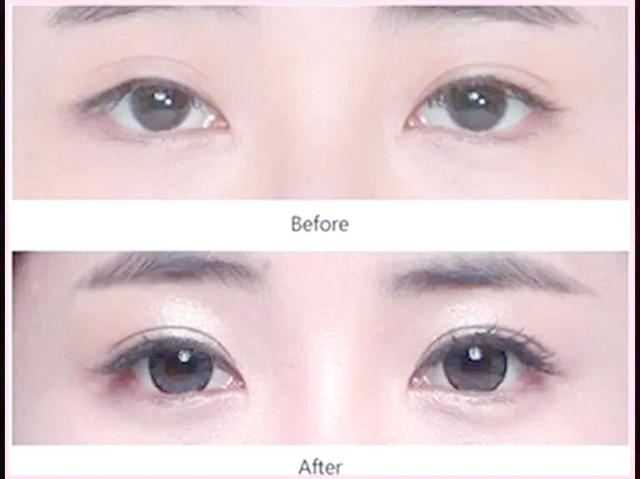 怀孕可以做双眼皮吗