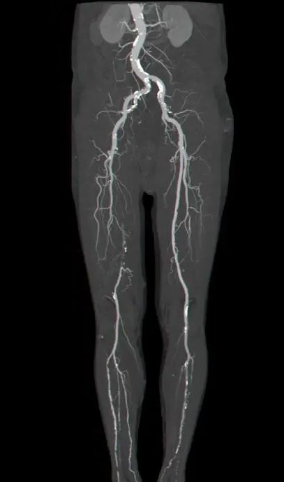 右下肢动脉栓塞什么意思