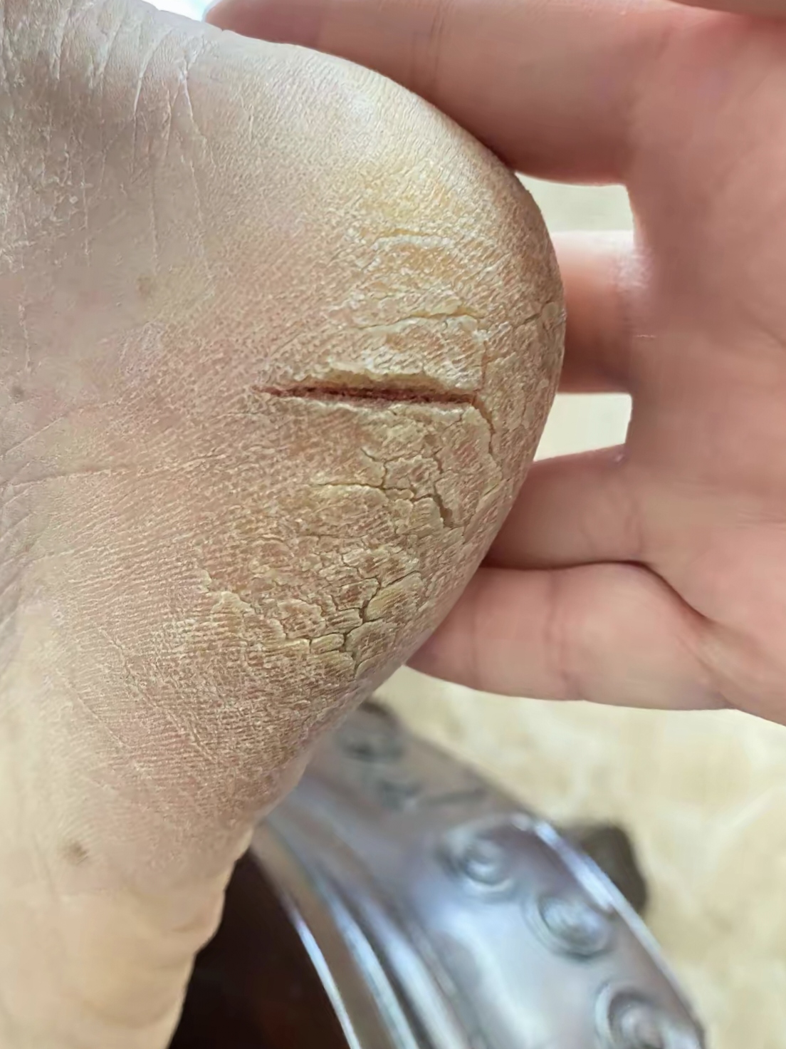 冬天脚跟裂是怎么回事?