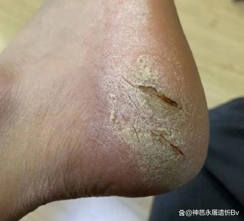 冬天脚跟裂是怎么回事?