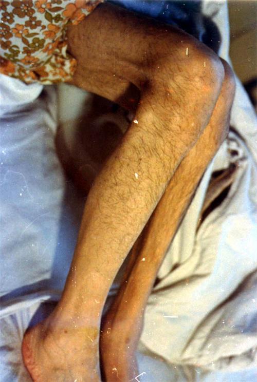 肌肉萎缩的早期症状有哪些