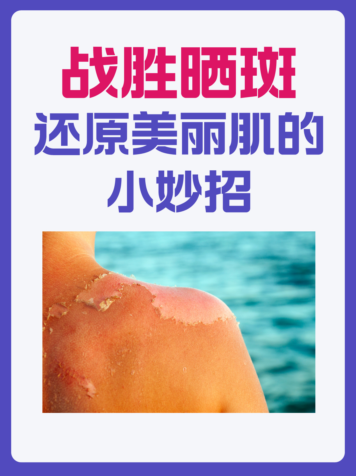 日晒斑是怎么回事,去日晒斑的方法?