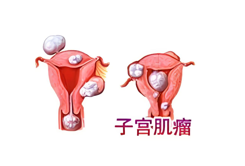 子宫肌瘤能吃鸡蛋吗