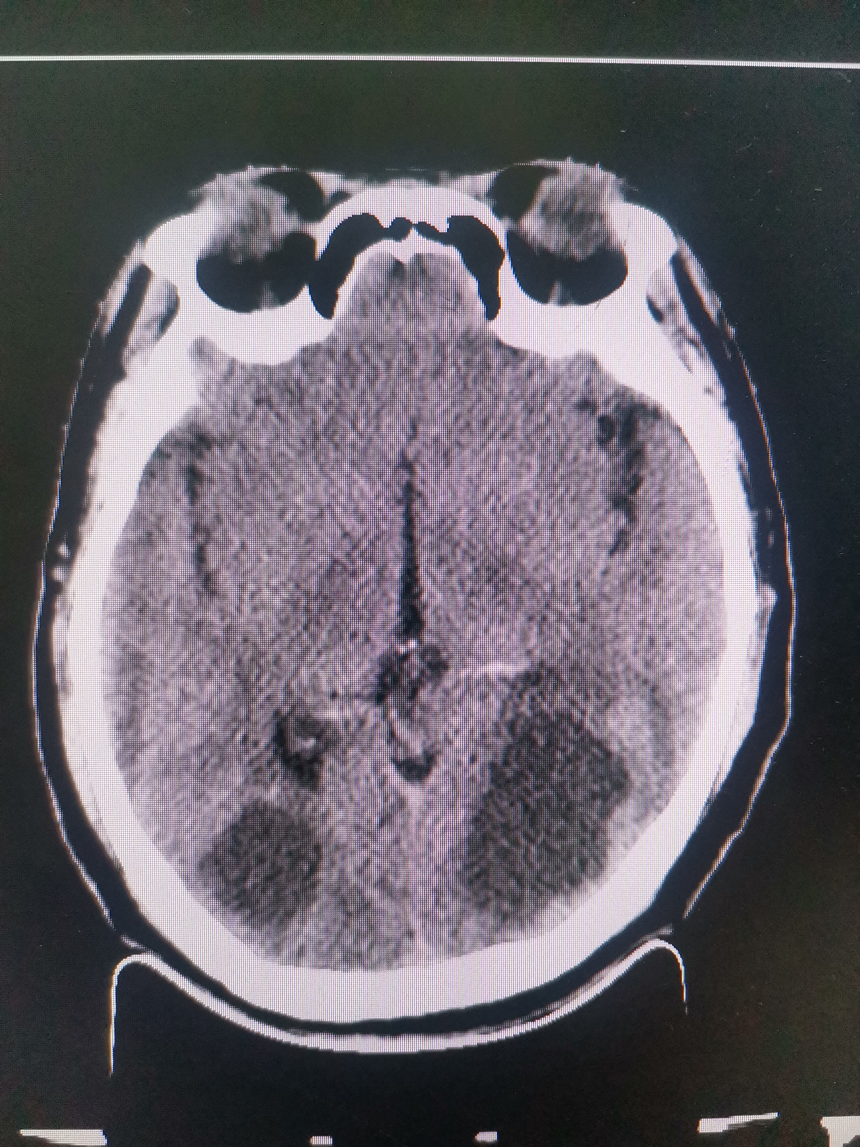 恶性脑瘤晚期症状
