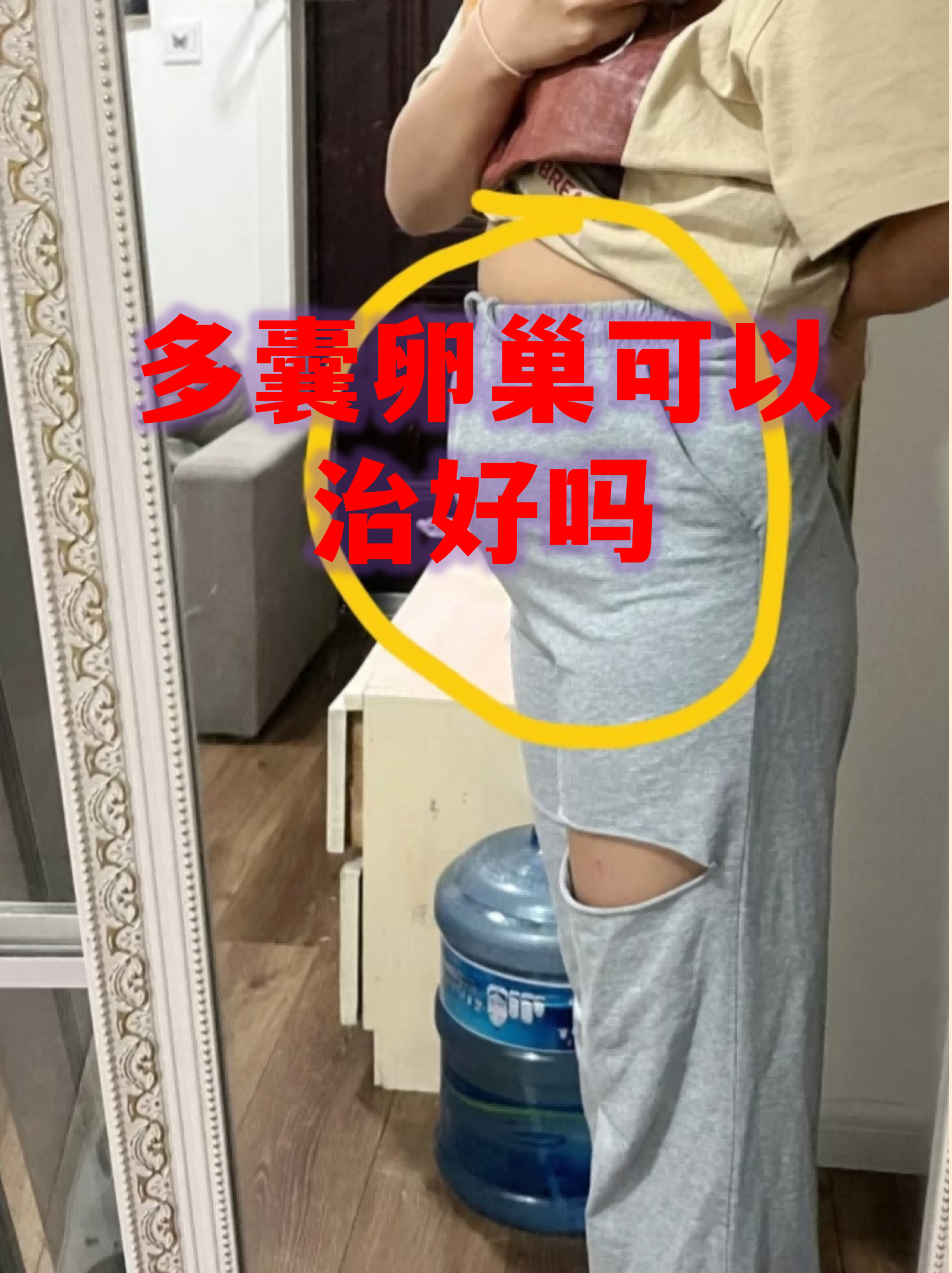 少女多囊卵巢综合症能治好吗