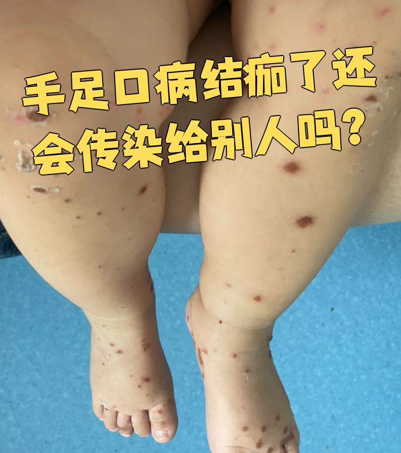 手足口病严重吗?