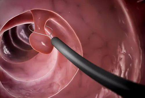 阴道口长了一个小肉球