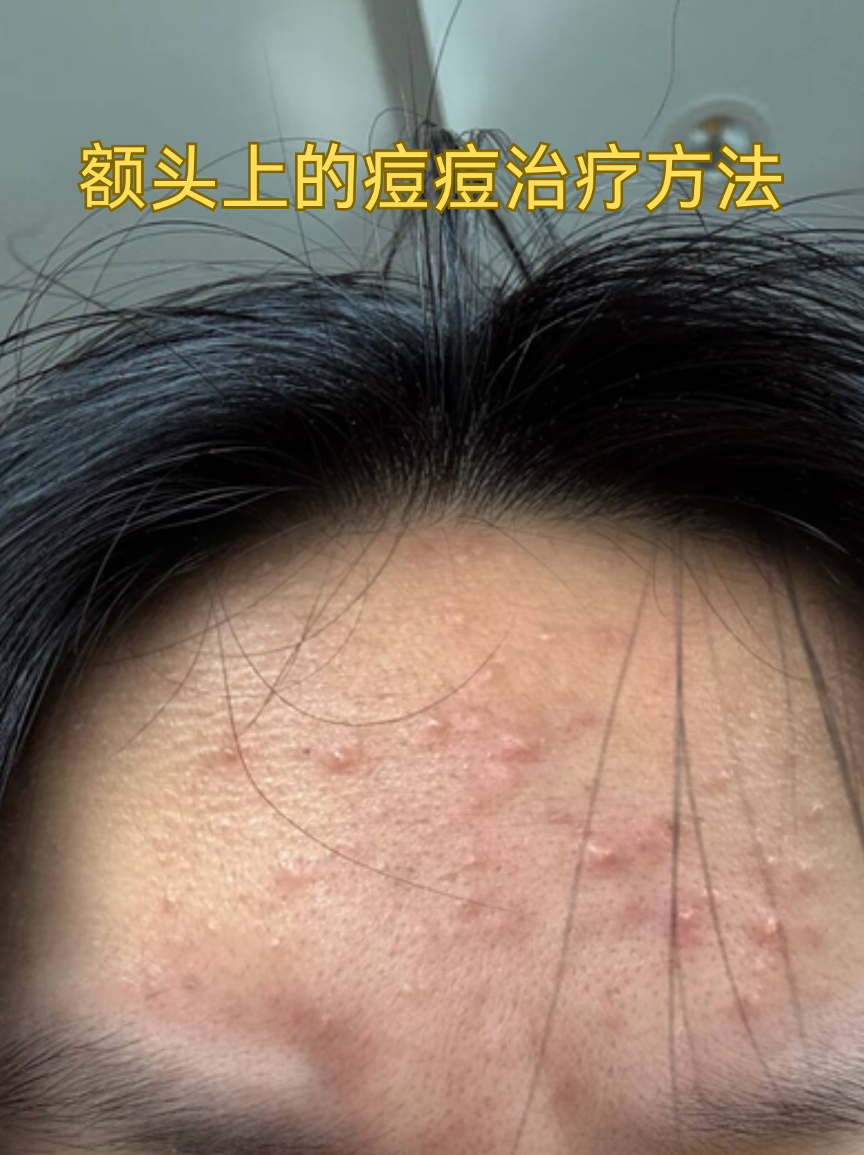 额头很多痘痘怎么办