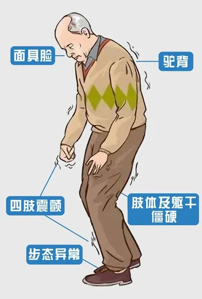 帕金森病的症状有哪些呢