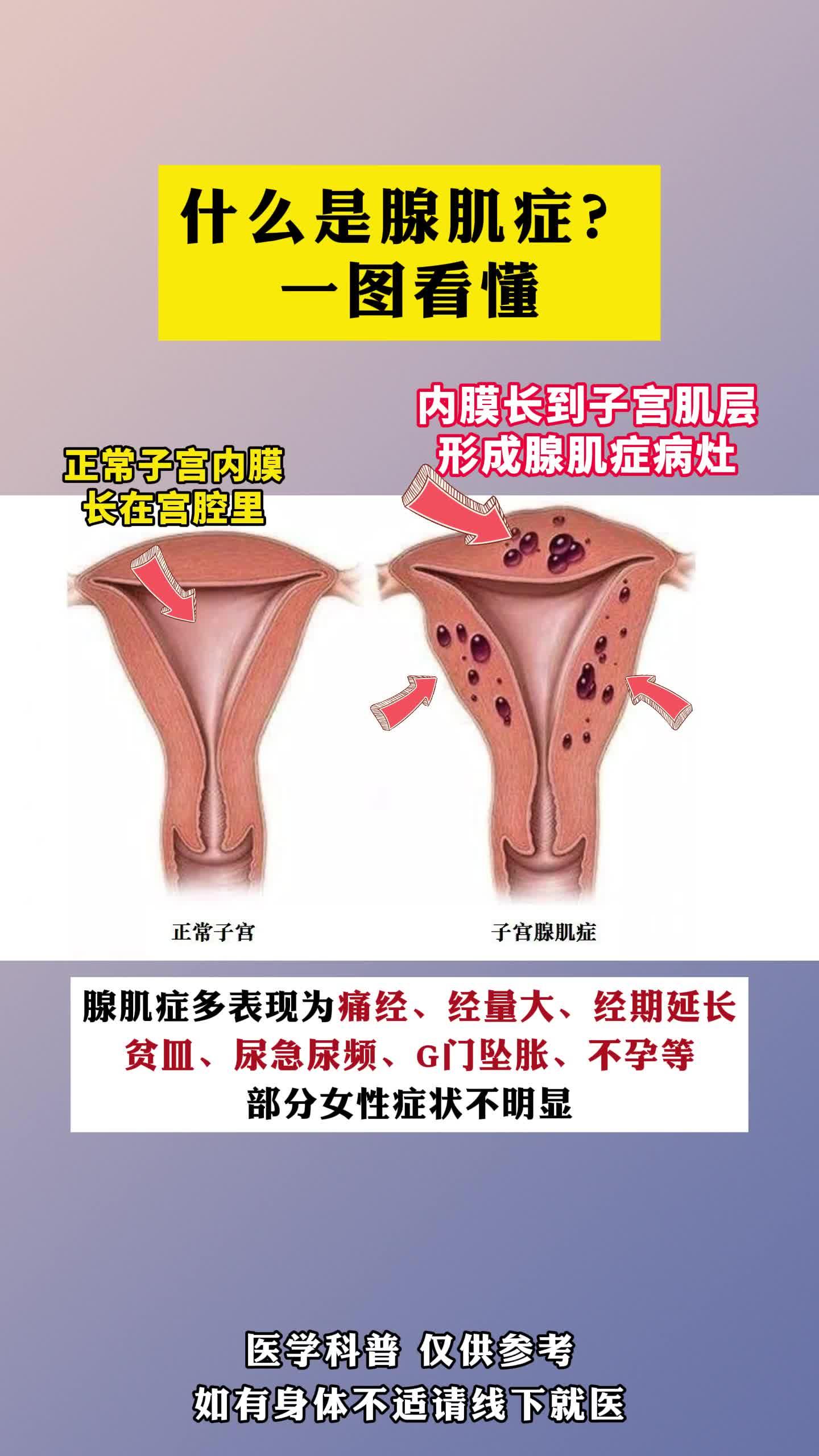 什么是子宫腺肌症