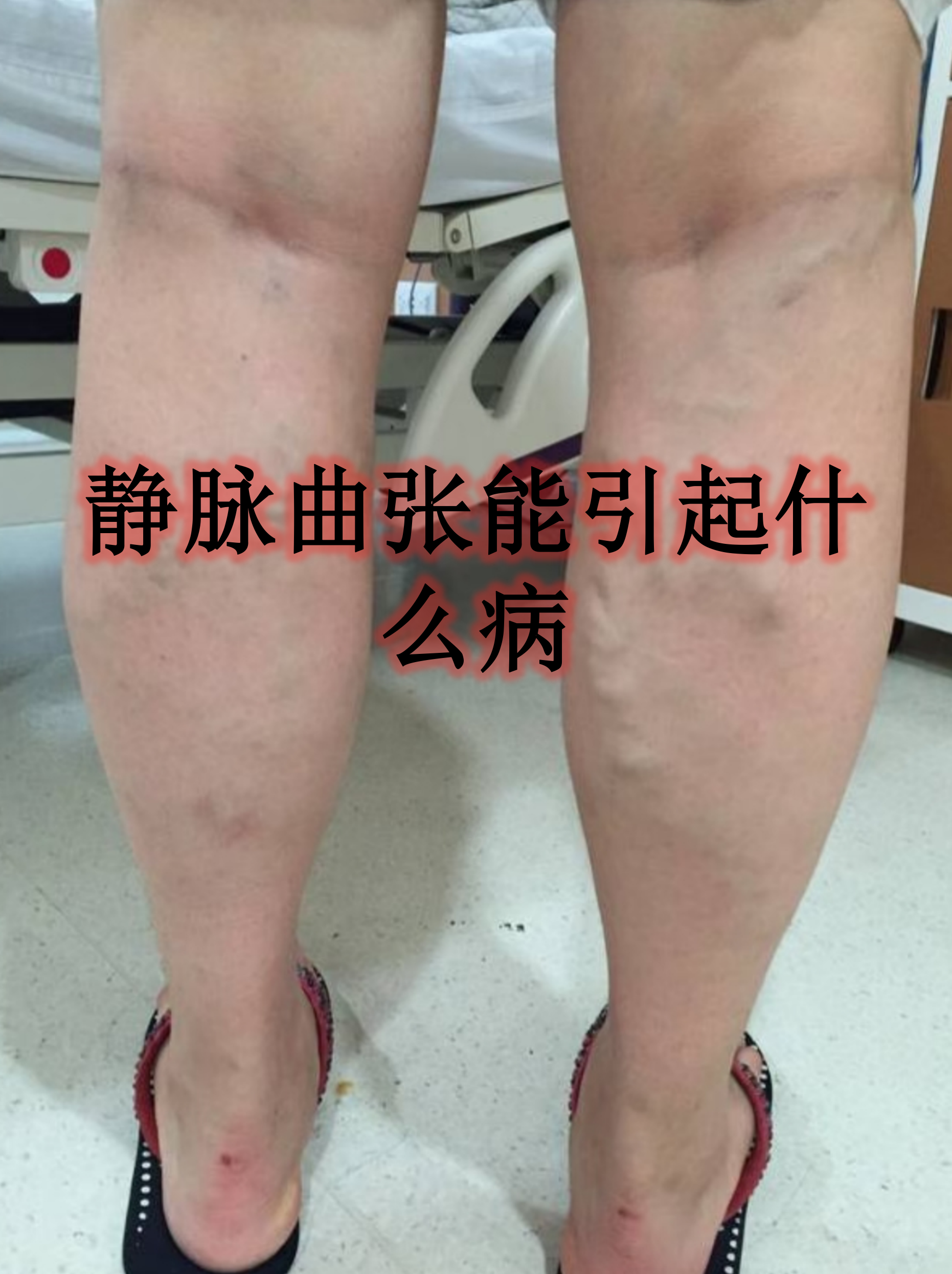 引起静脉曲张的主要原因是什么