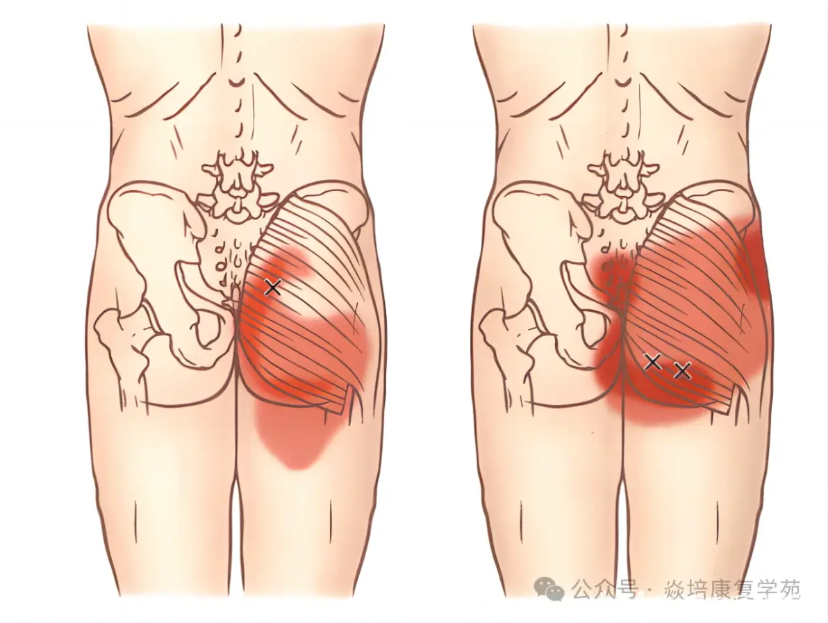 屁股肌肉疼痛是怎么回事