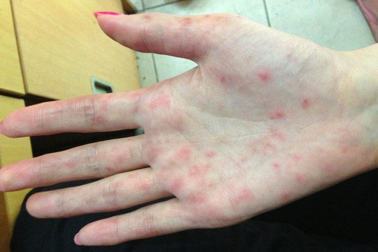 手心长红点有点痒怎么回事
