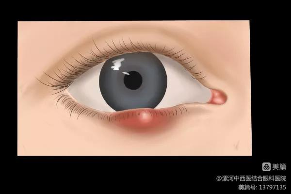 散粒肿和麦粒肿有什么区别