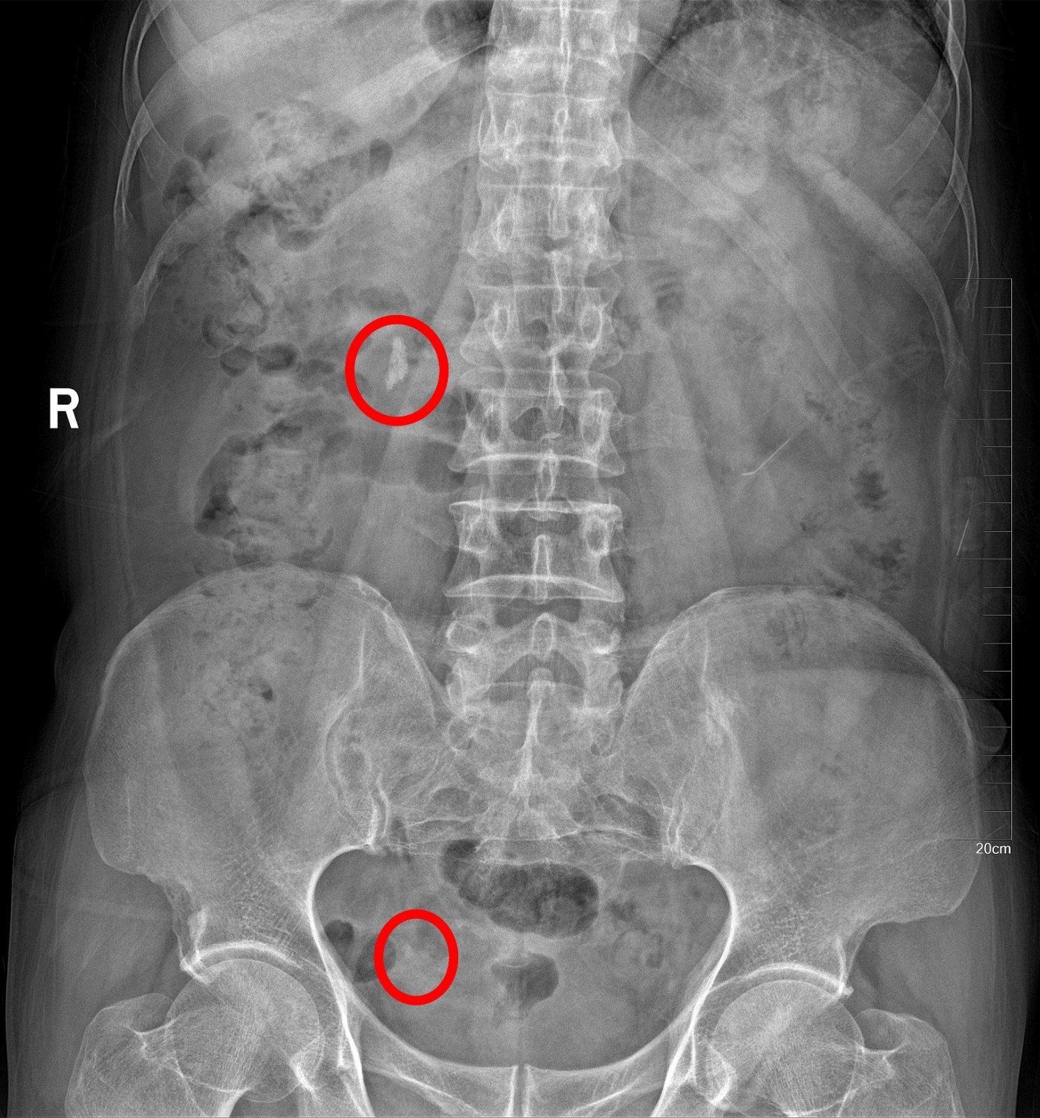 0.7厘米结石卡在输尿管下段