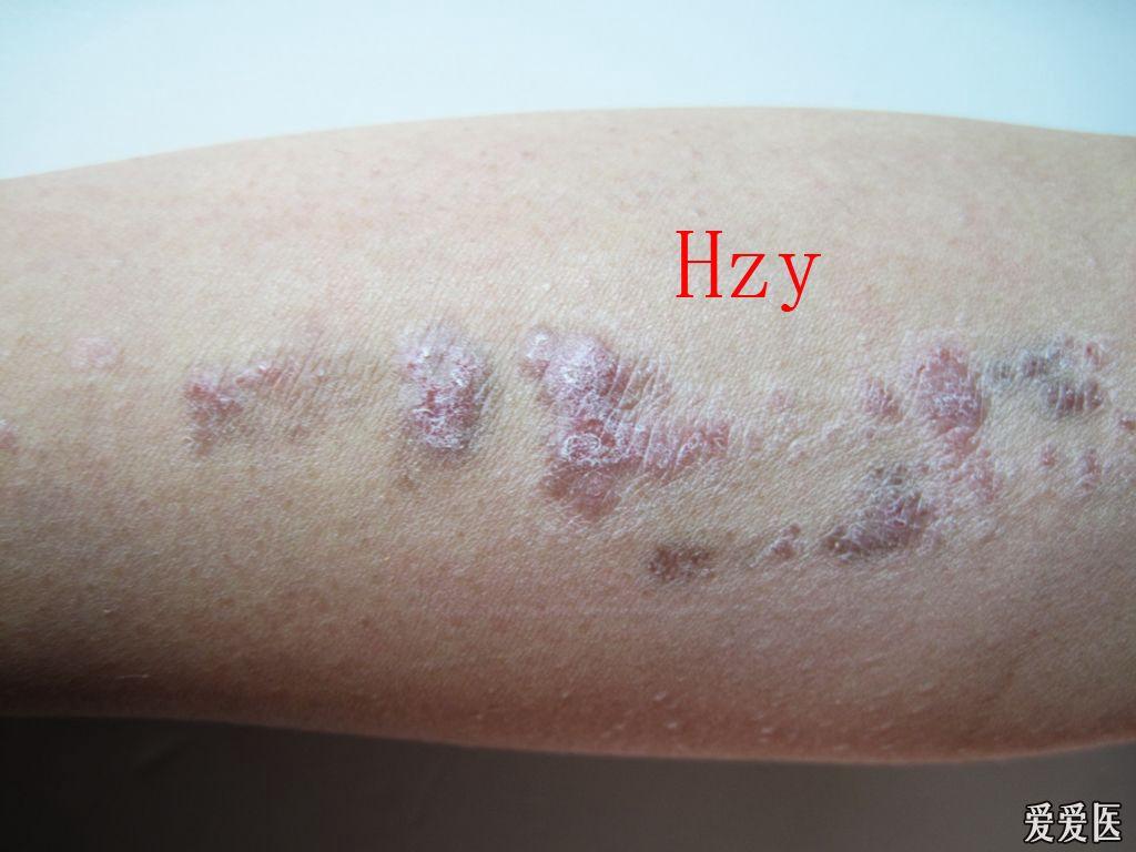 线状苔藓的具体表现及治疗