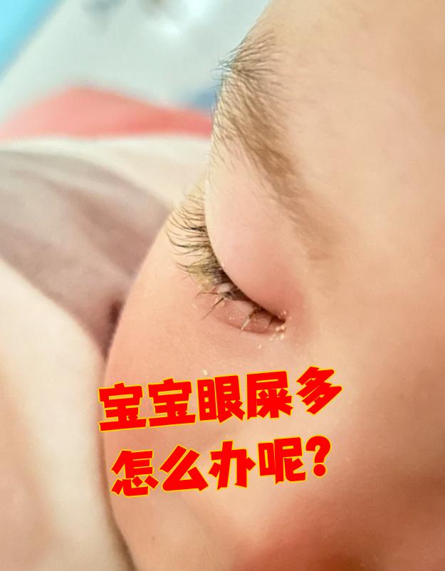 小孩眼屎多怎么回事