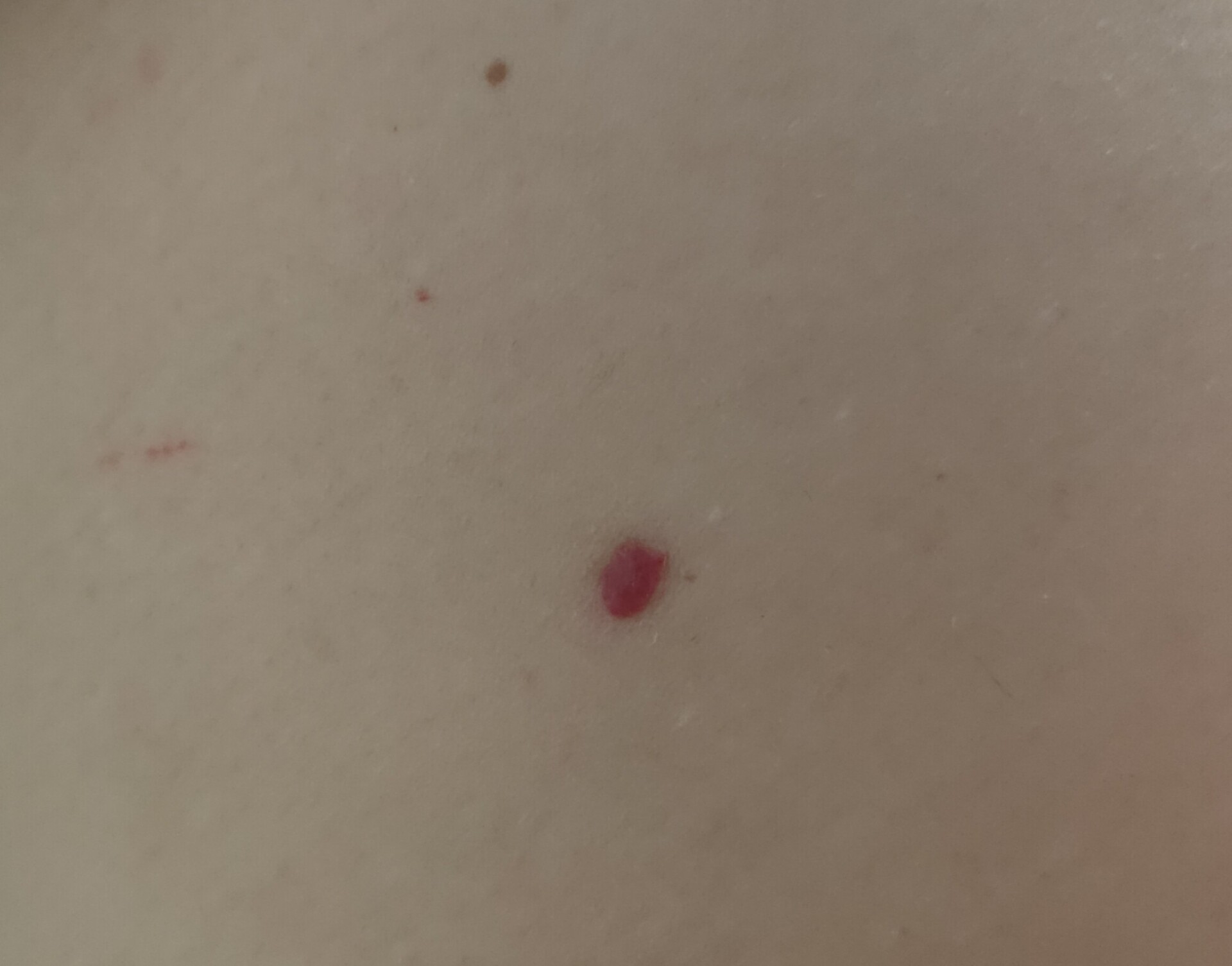 身上长小红点不痛不痒