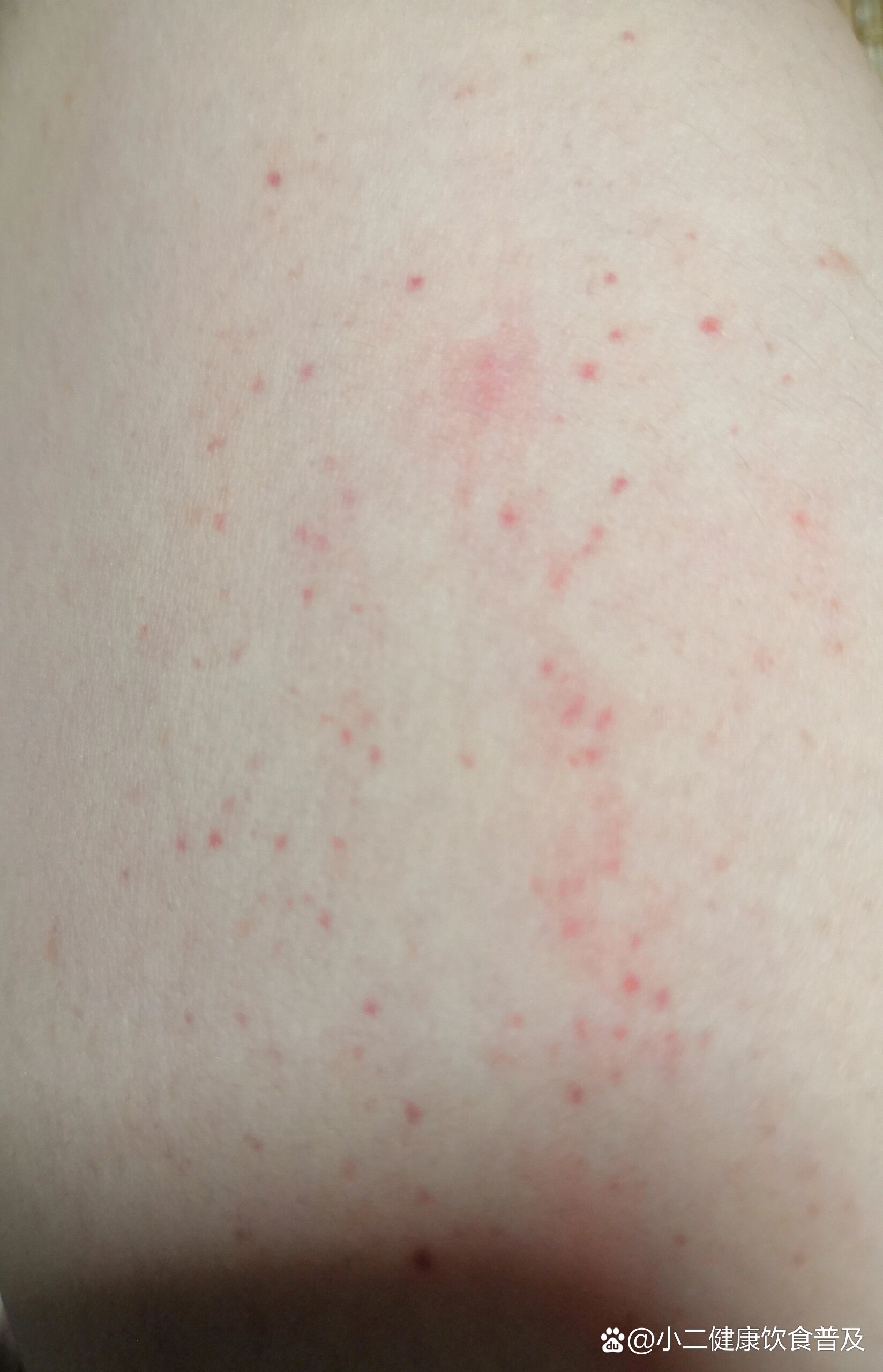身上长小红点不痛不痒