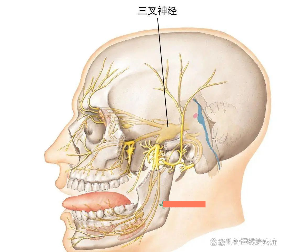 三叉神经痛是怎么引起的