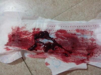 月经血块两坨,经痛有图