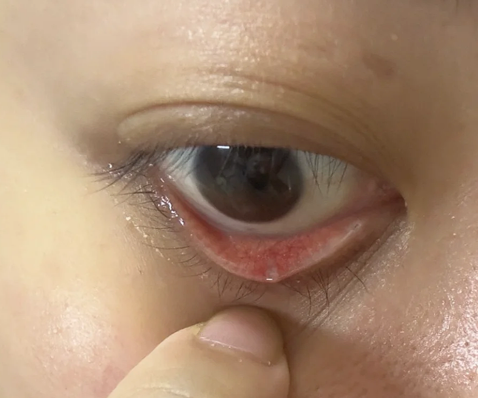 内眼睑上长透明小颗粒怎么办