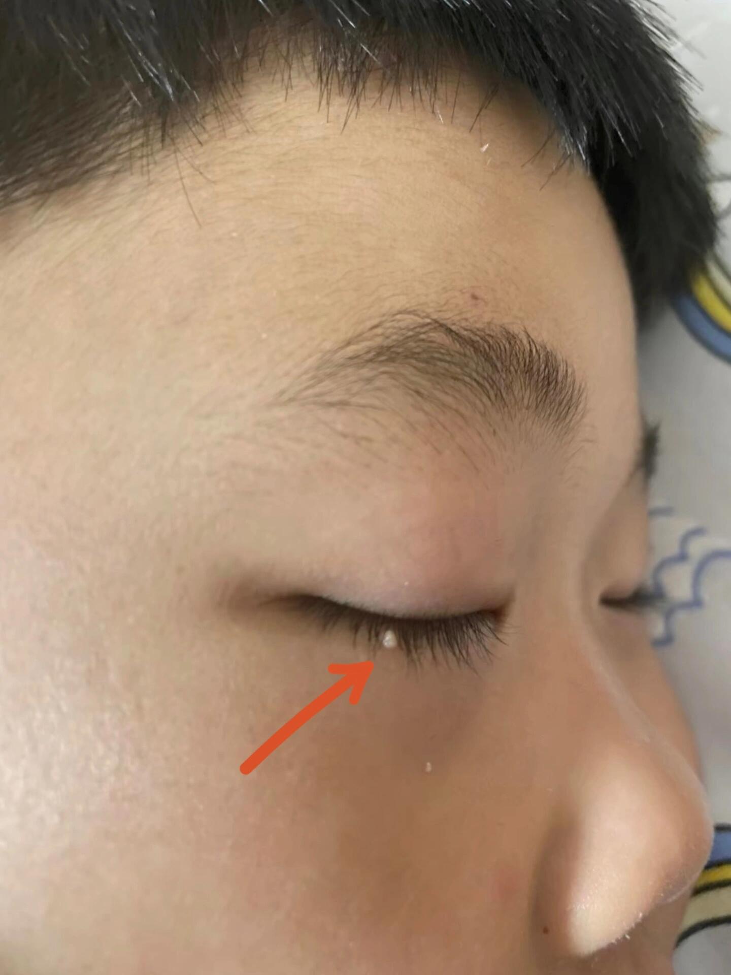 内眼睑上长透明小颗粒怎么办