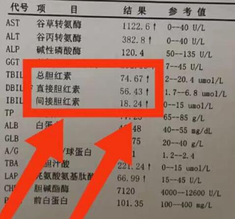 肝功能检查直接胆红素偏高一点