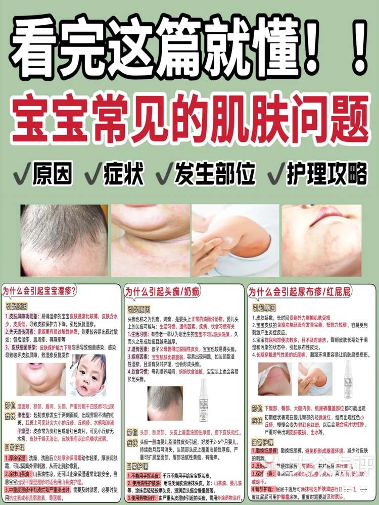 小孩脸上长痱子怎么办