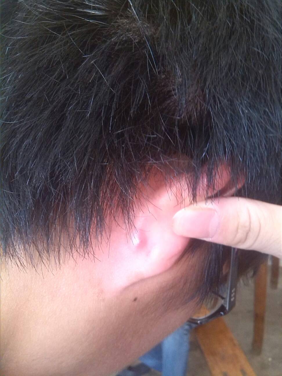 耳垂下长了一个硬疙瘩