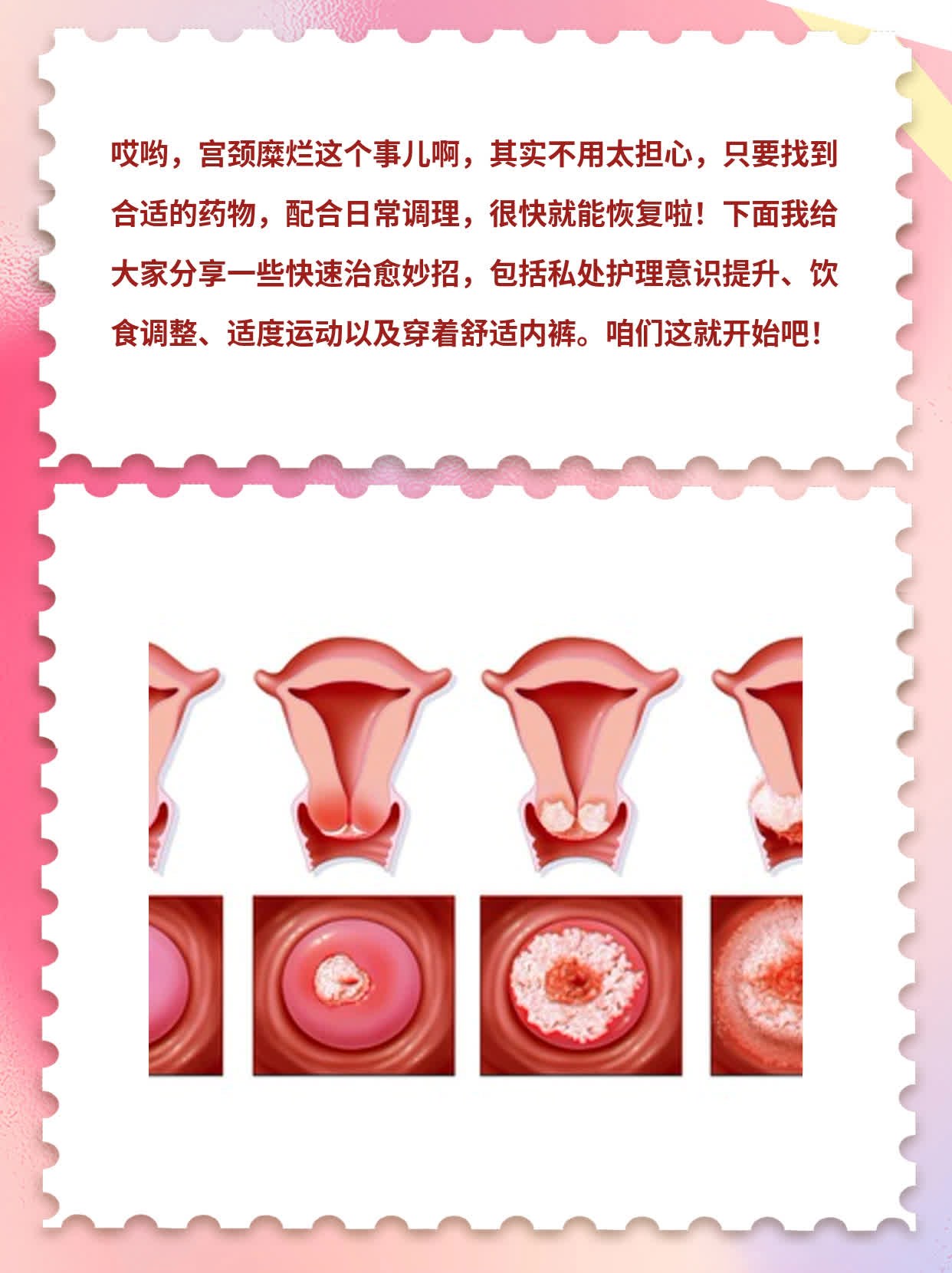 宫颈糜烂要怎么办?