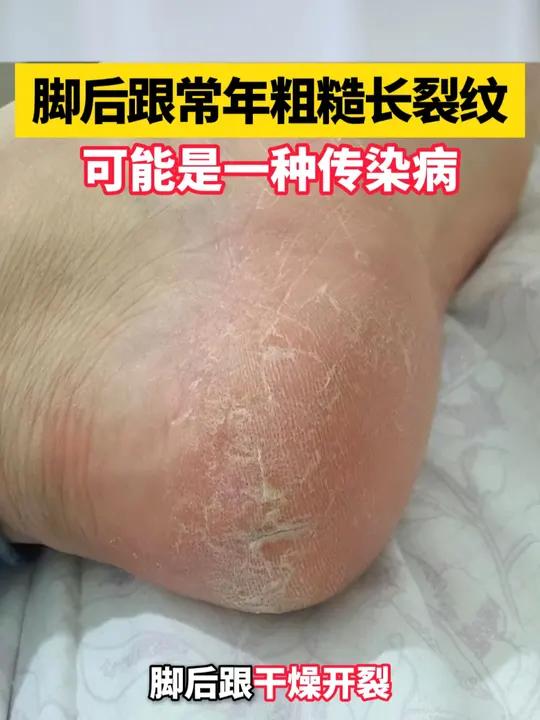 脚后跟干裂是什么原因
