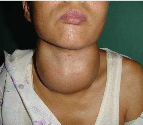 甲亢早期的症状表现