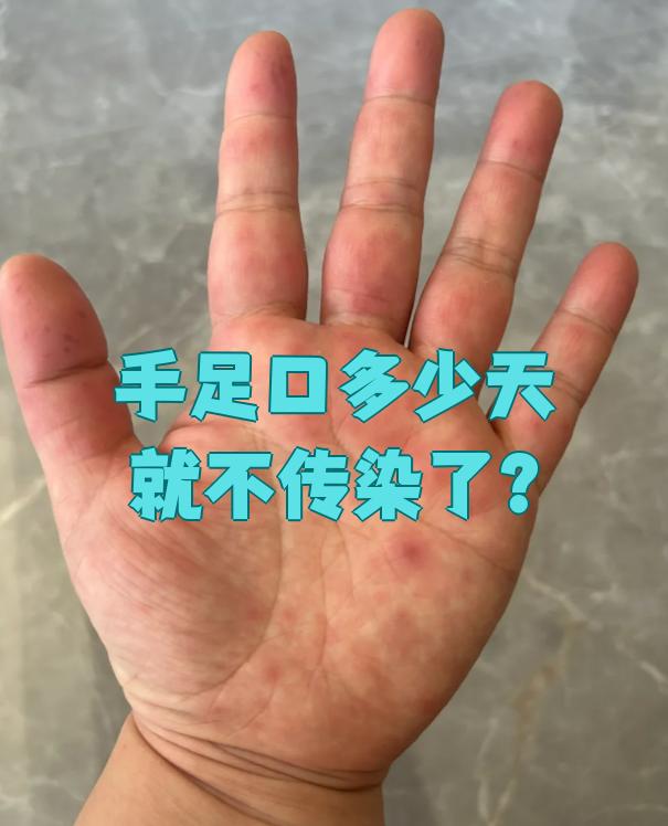 手足口病挂哪个科室?