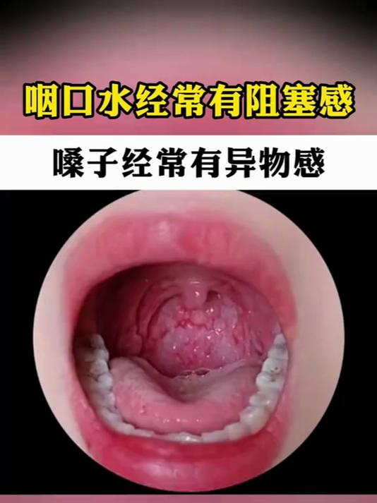 嗓子不舒服,吞咽有异物感