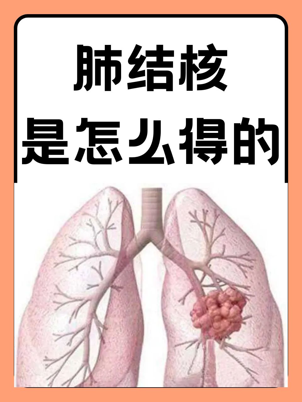 肠结核的症状