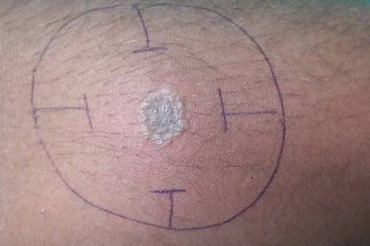 破伤风皮试阳性是什么情况