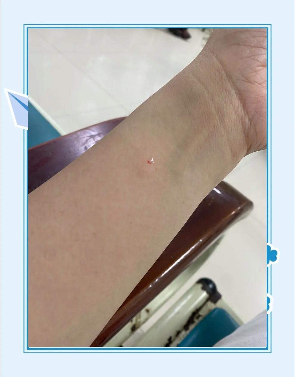 破伤风皮试阳性是什么情况