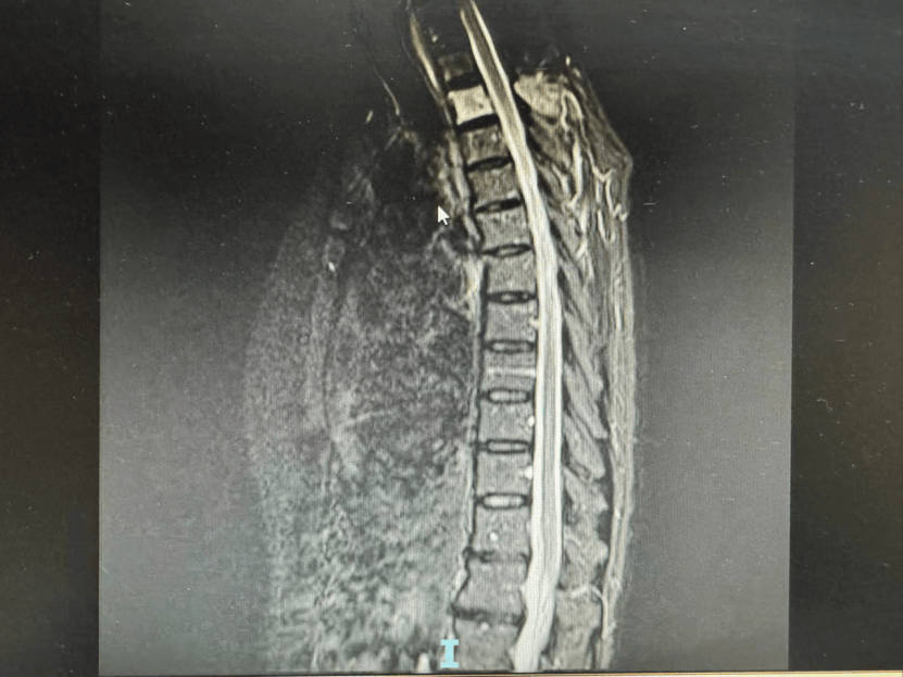 骨转移瘤能治好吗