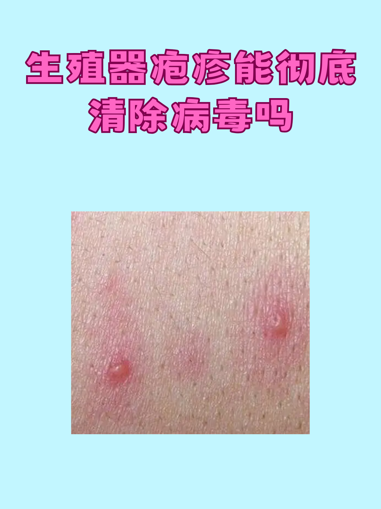 什么是单纯疱疹病毒感染症?