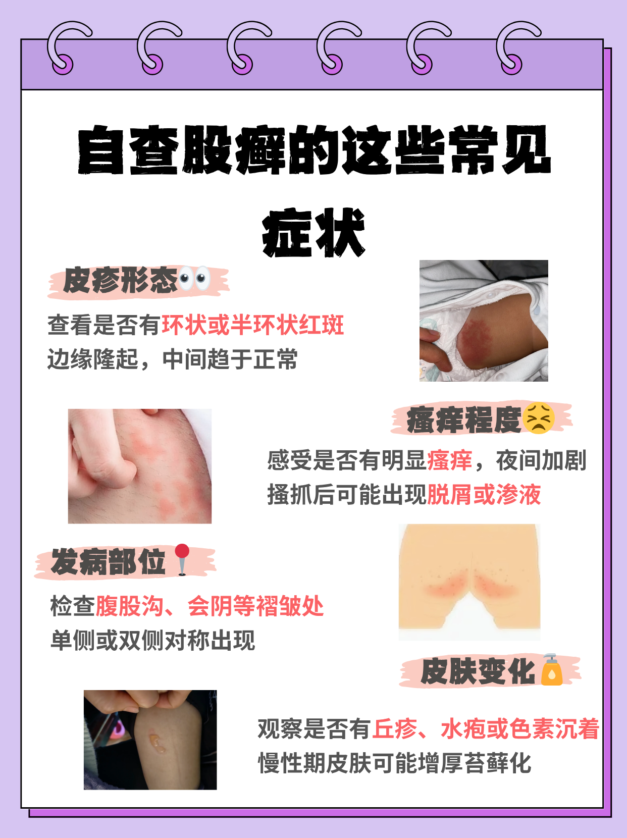 大腿肚内侧股癣怎么办?