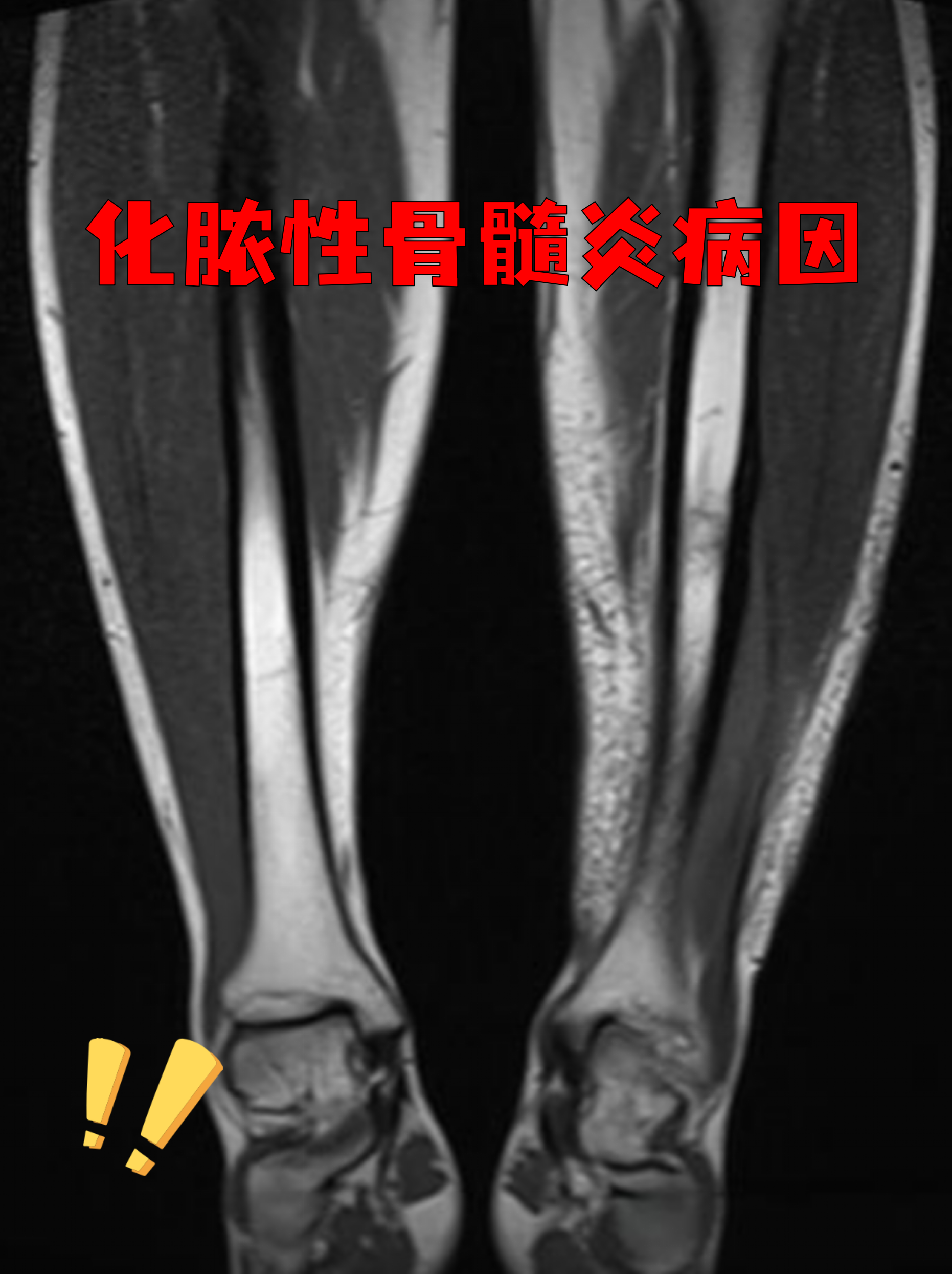 什么是急性血源性骨髓炎?