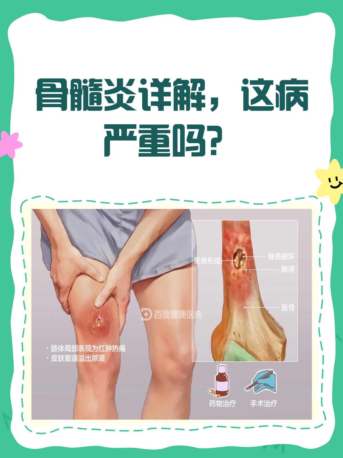 什么是急性血源性骨髓炎?