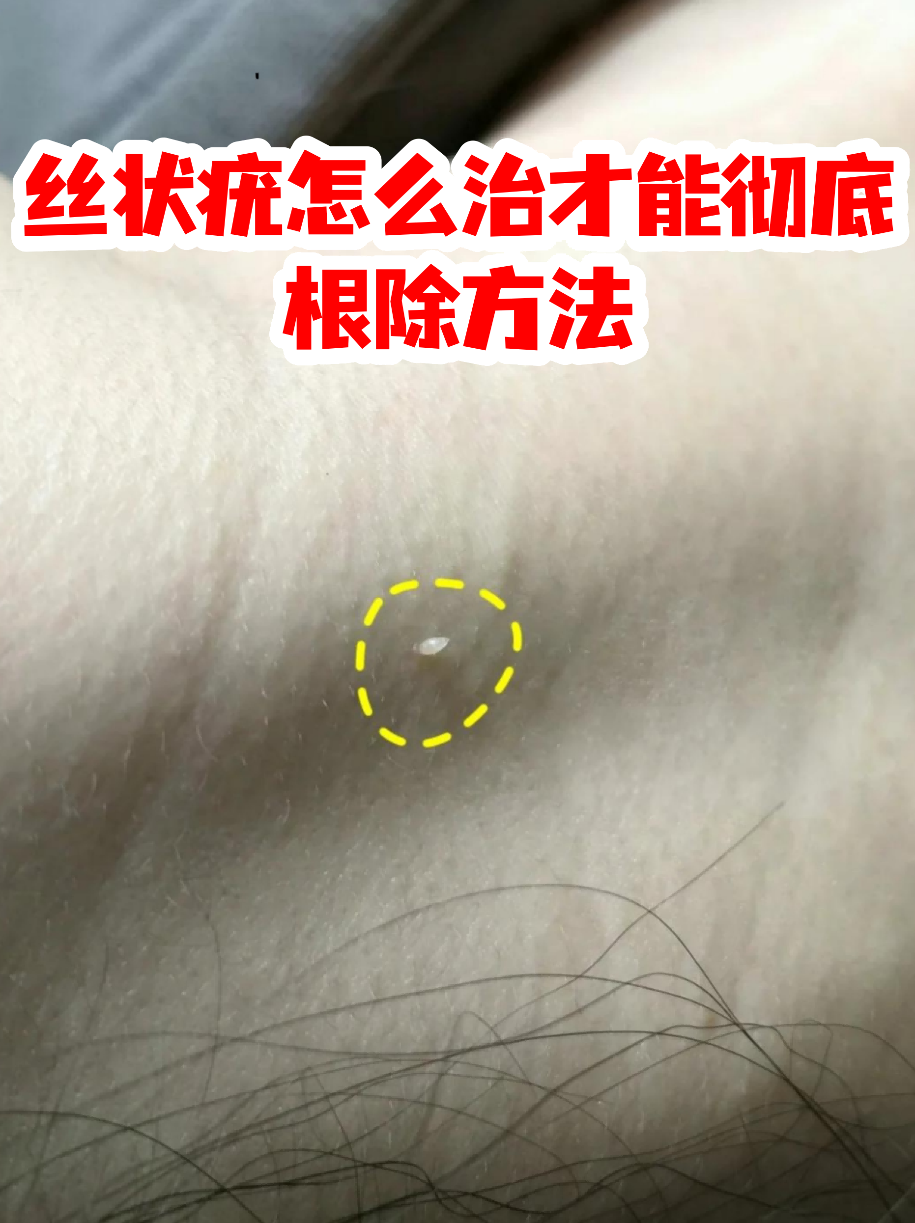 脖子上丝状疣怎么治