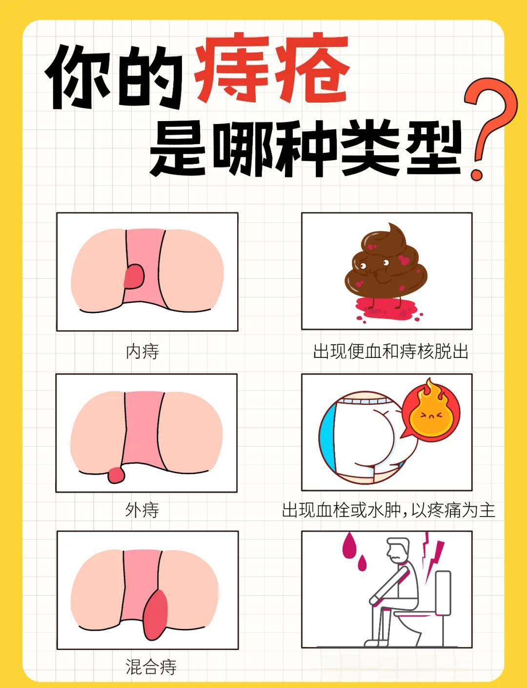 内痔的症状哪些