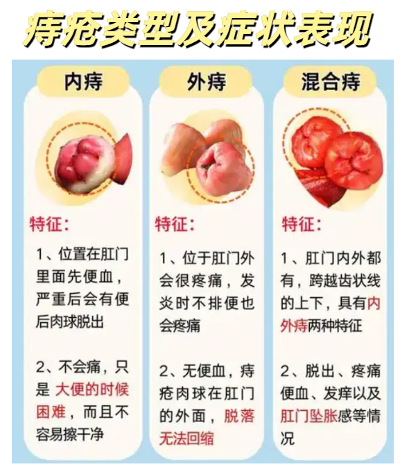 内痔的症状哪些