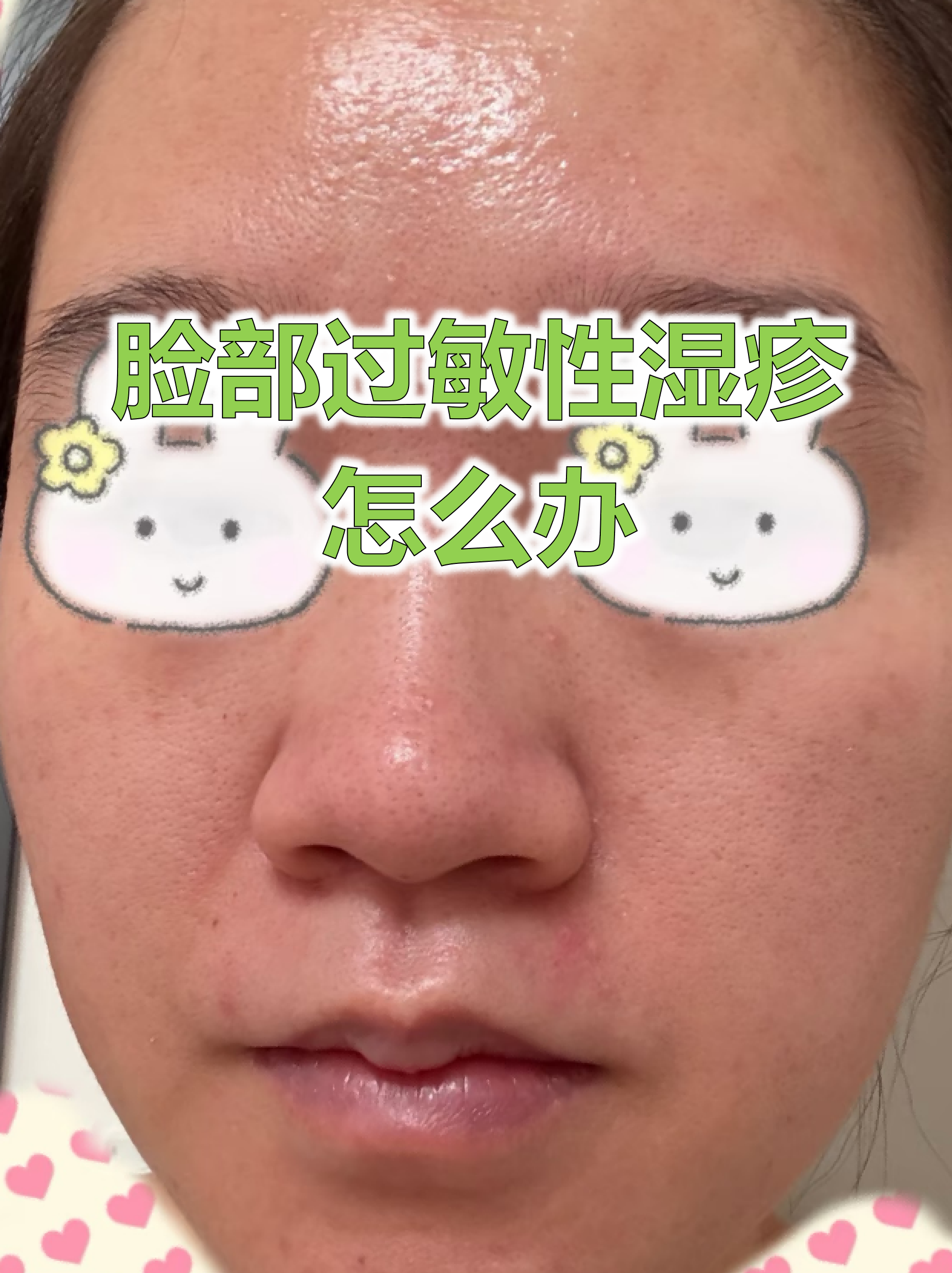 面部皮肤过敏,红肿怎么办