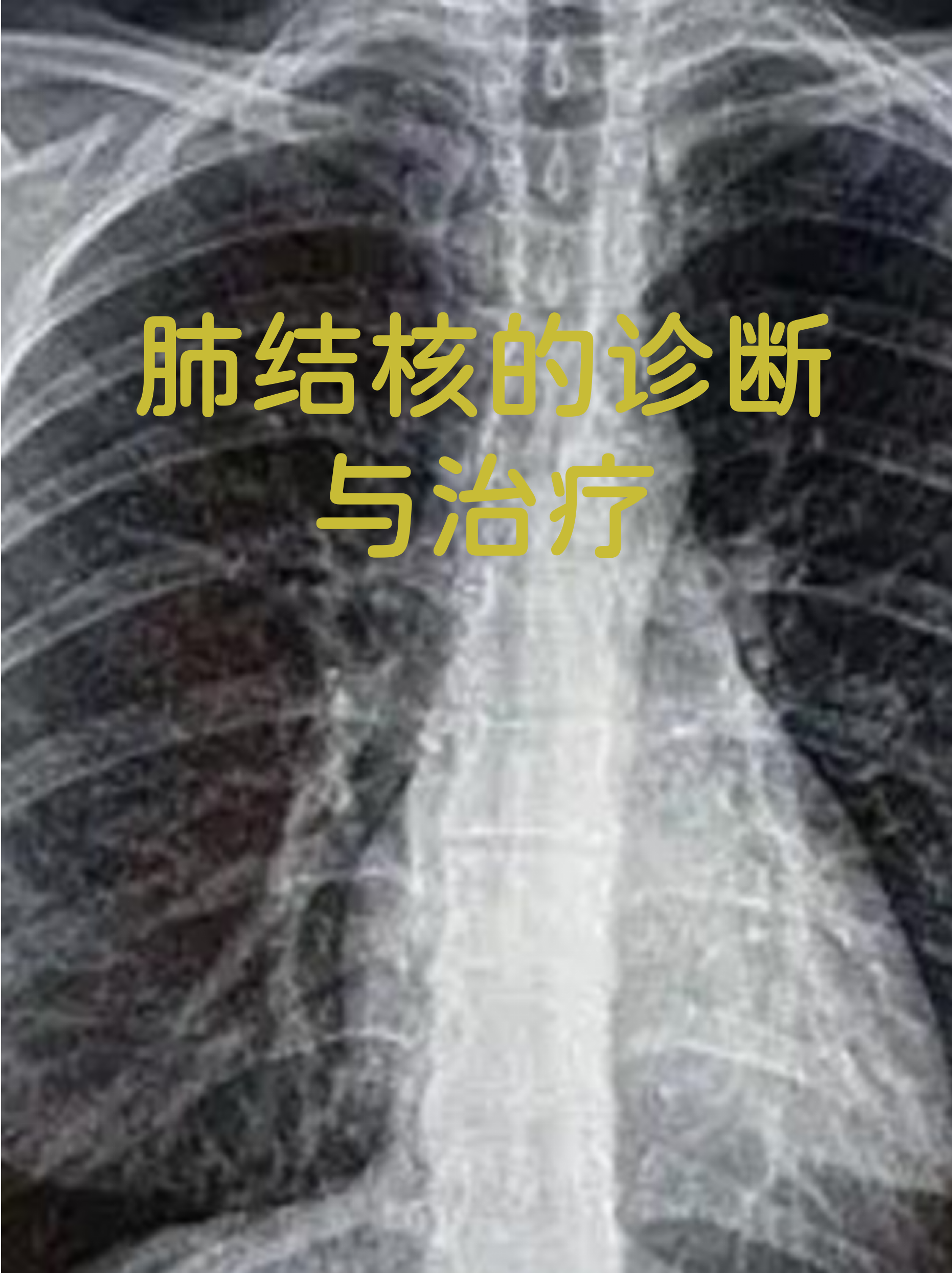 肺结核初期是什么症状