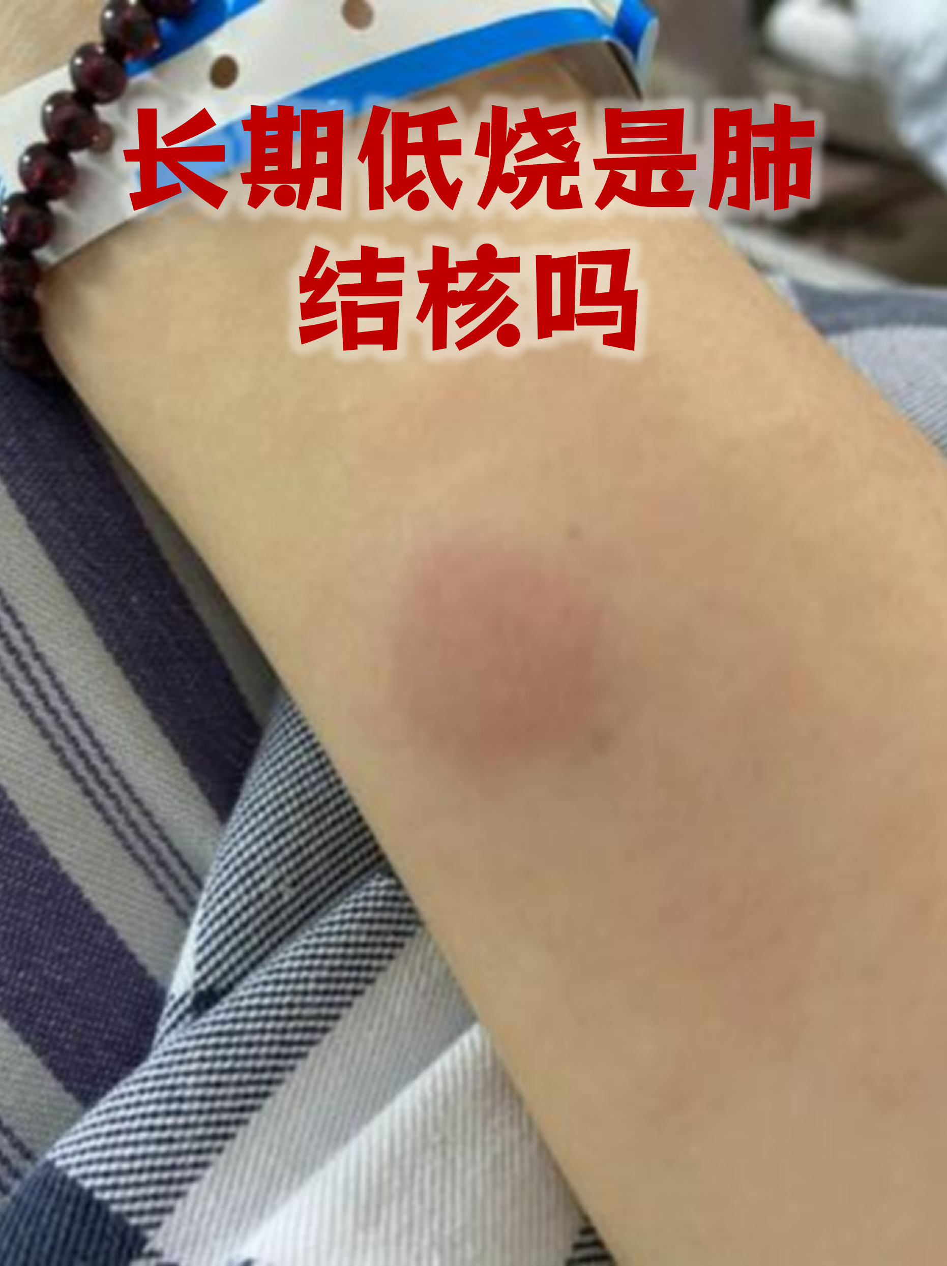 肺结核初期是什么症状