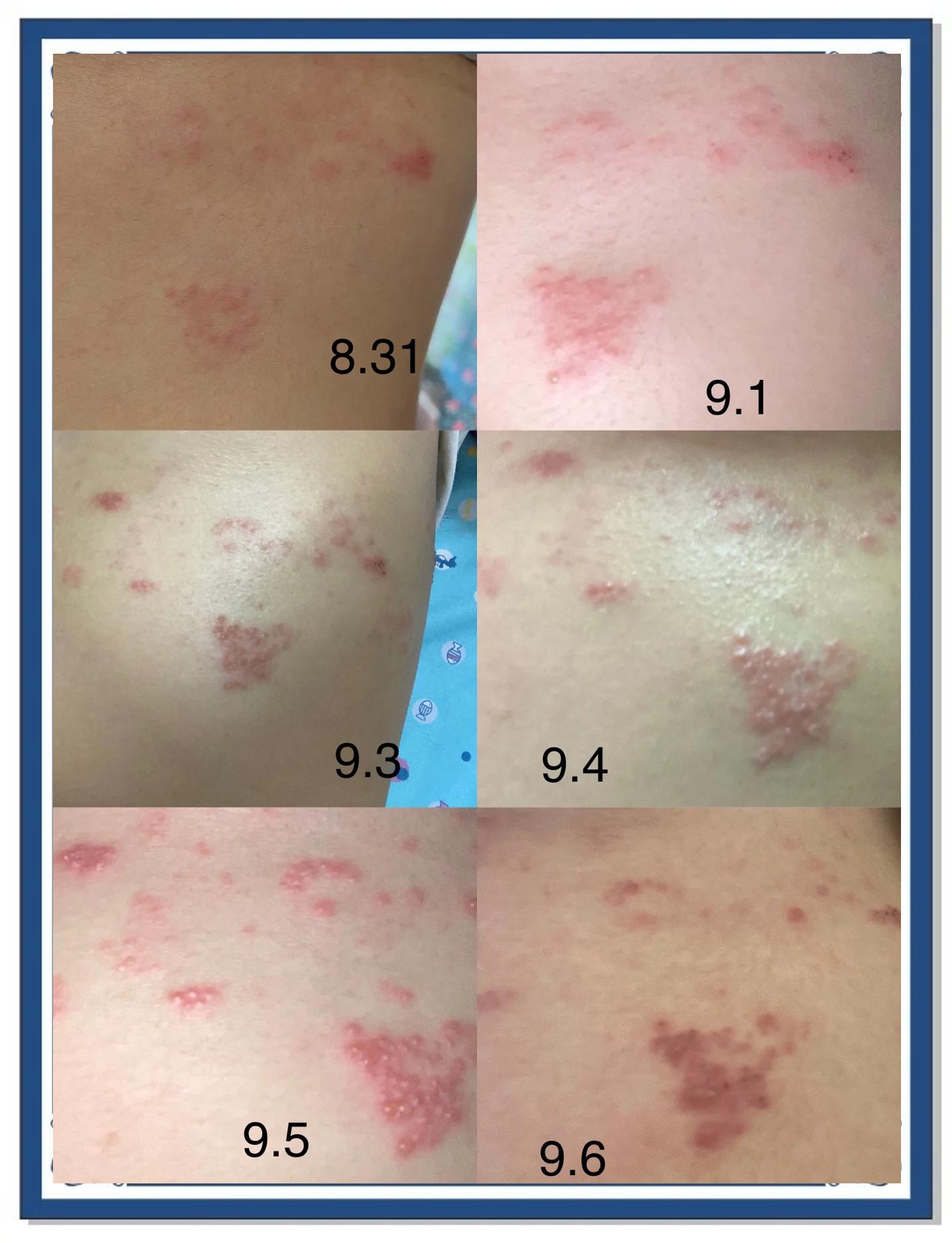 请问缠腰丹最初症状是怎样的?痒痒,但不疼